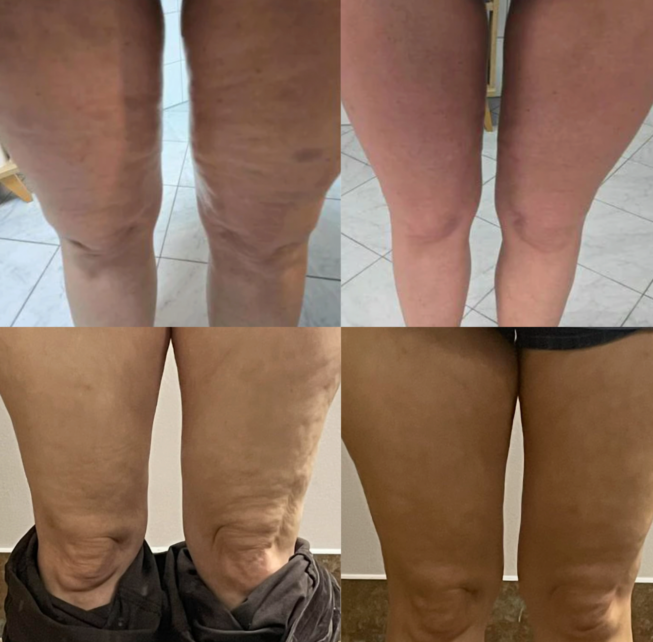 Rollerris™ – Lymphatic Massage Roller